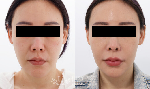  ULTHERAPY PRIME 美國音波二代－案例1(正面)