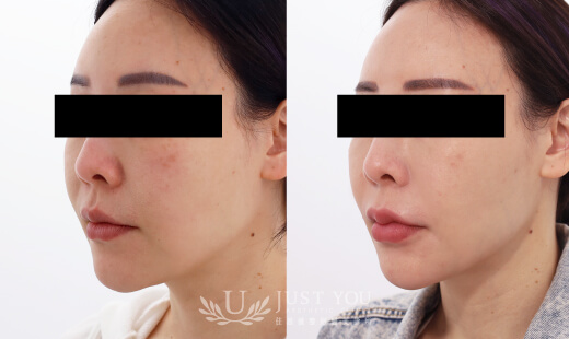 ULTHERAPY PRIME 美國音波二代－案例1(側面)