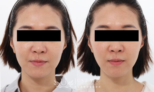  ULTHERAPY PRIME 美國音波二代－案例2(正面)