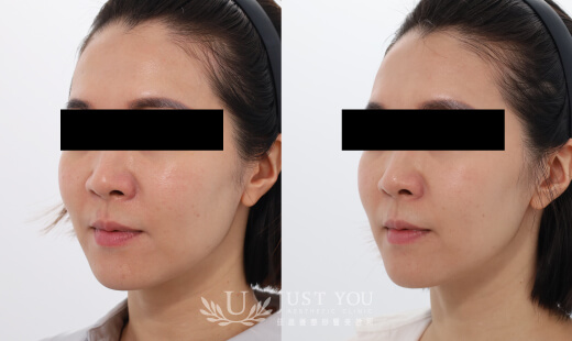 ULTHERAPY PRIME 美國音波二代－案例2(側面)