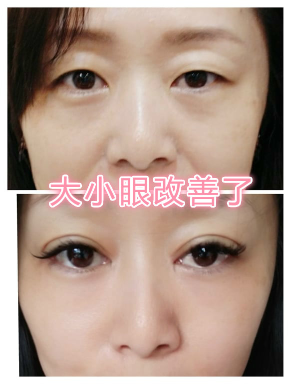 雙眼皮手術後，改善大小眼的問題