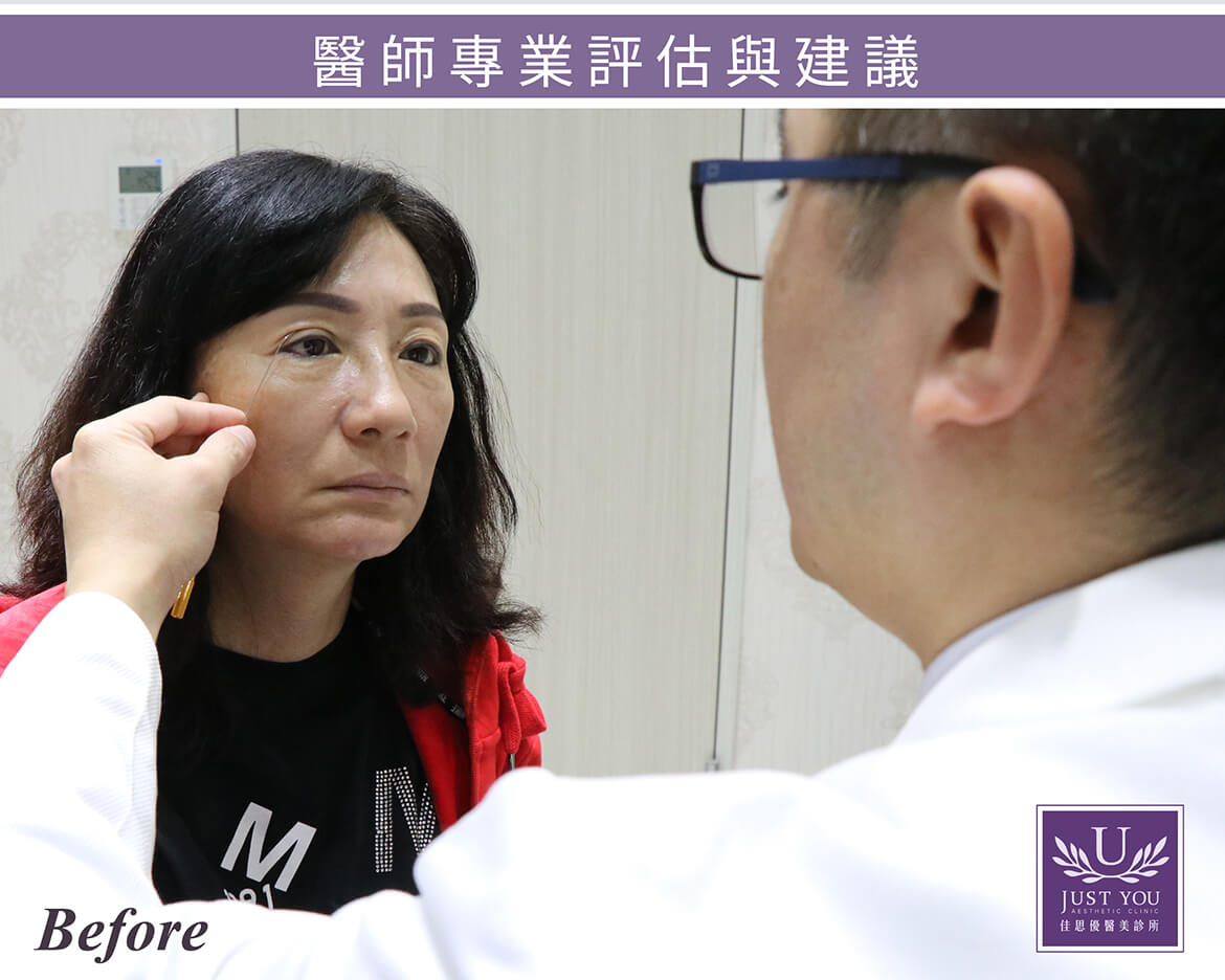 雙眼皮手術+提眼瞼肌醫師諮詢