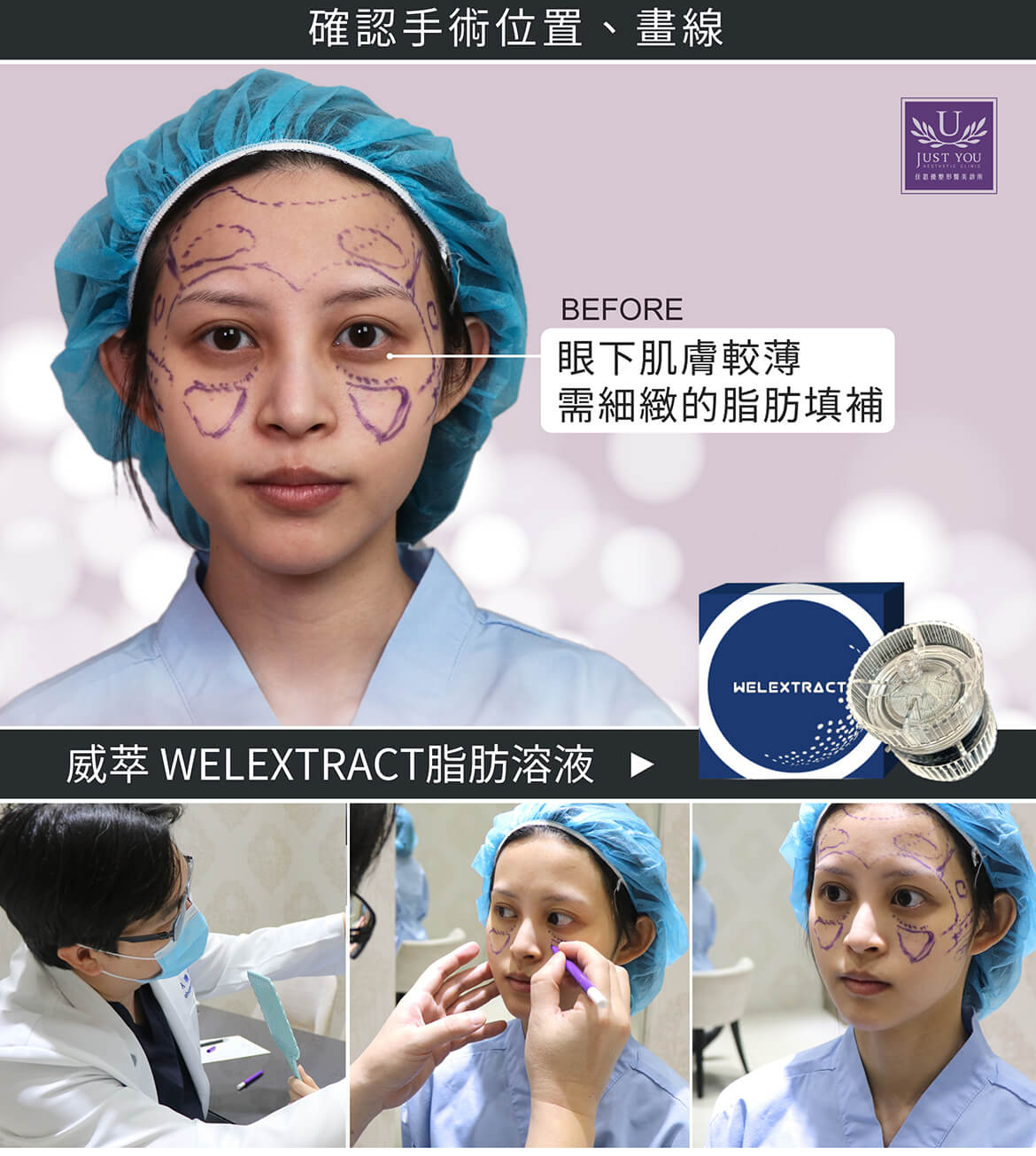 WELEXTRACT威萃脂肪溶液全臉補脂手術《確認手術位置、畫線》
