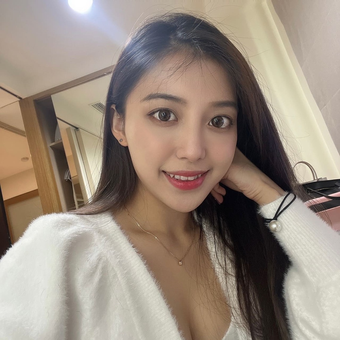 佳思優整形醫美診所微整形專家郭聿書醫師進口玻尿酸補淚溝後