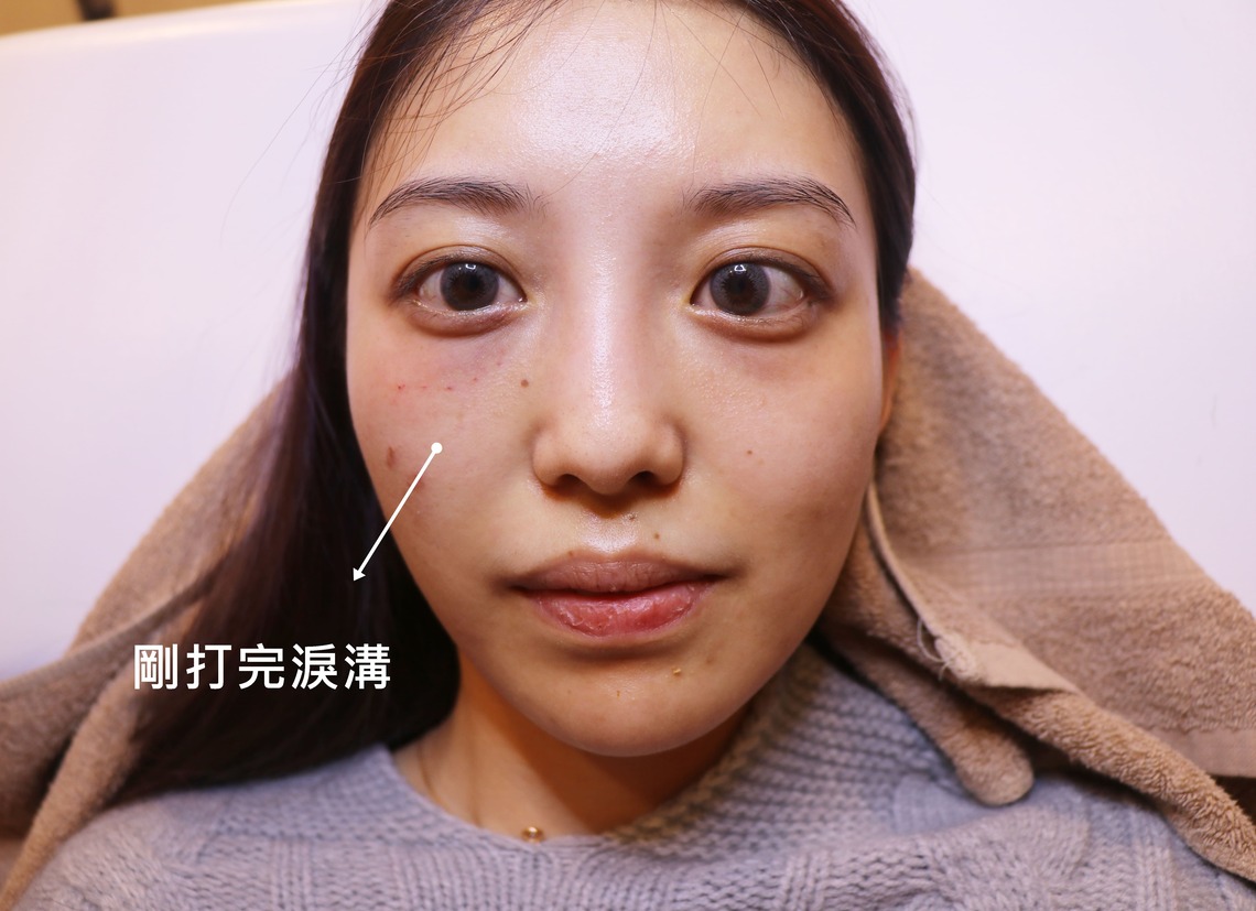 佳思優整形醫美診所微整形專家郭聿書醫師玻尿酸補淚溝治療後左右臉比較