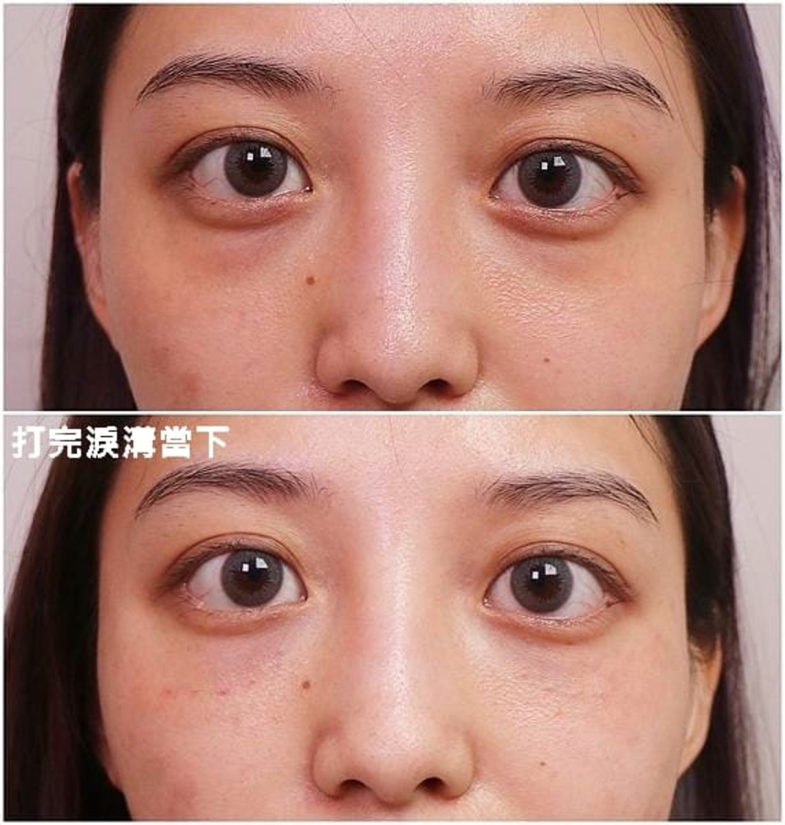 佳思優整形醫美診所微整形專家郭聿書醫師玻尿酸補淚溝治療後當下