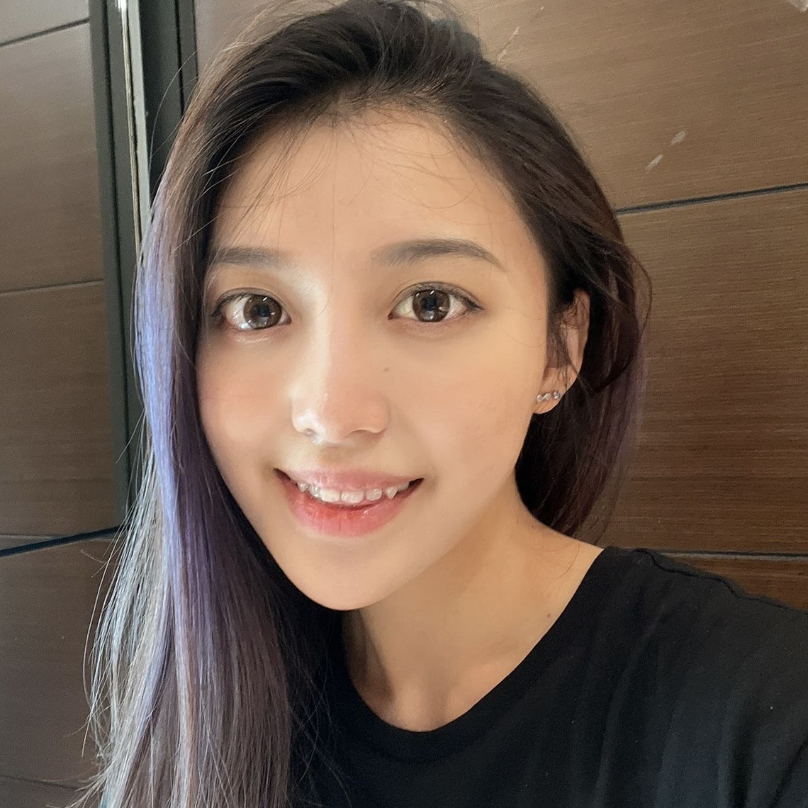佳思優整形醫美診所微整形專家郭聿書醫生玻尿酸補淚溝治療後