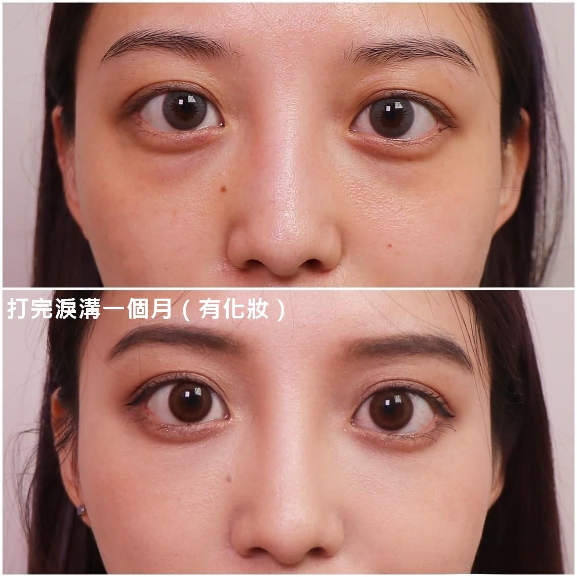 佳思優整形醫美診所微整形專家郭聿書醫生玻尿酸補淚溝治療前後