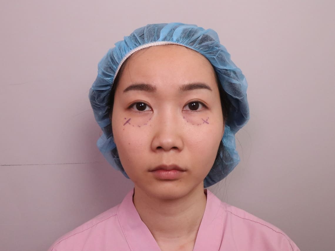 佳思優整形醫美診所院長黃仁吳醫師五合一隱痕眼袋內開手術加淚溝回填術前記錄