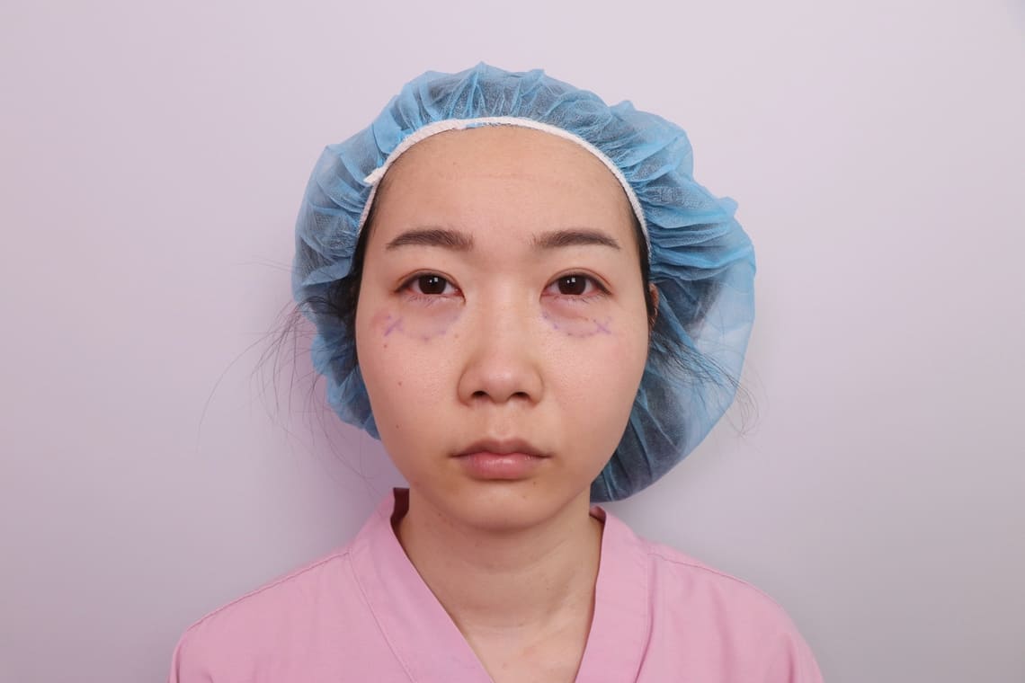 佳思優整形醫美診所院長黃仁吳醫師五合一隱痕眼袋內開手術加淚溝回填術後當下