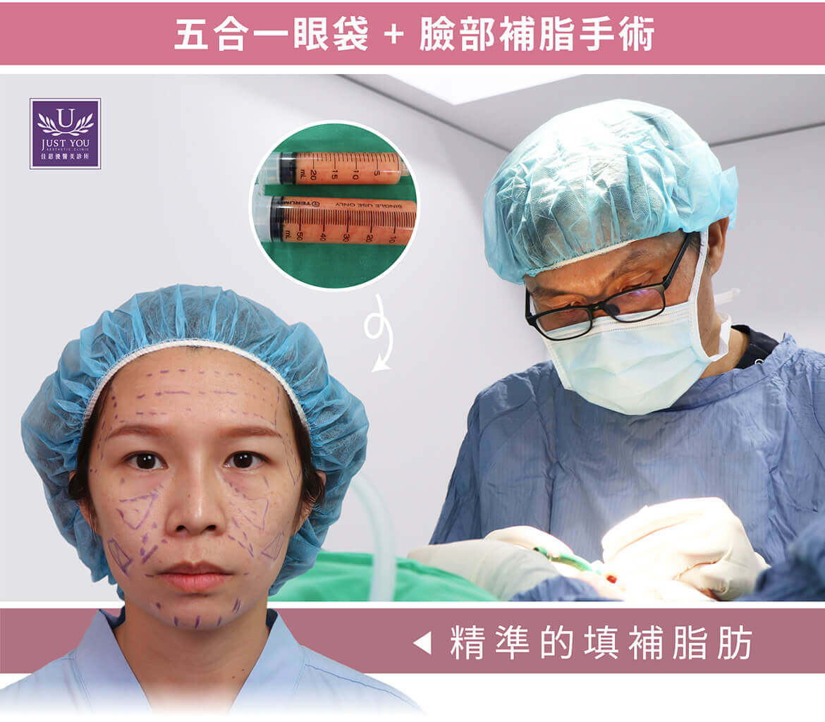 眼袋手術+精準自動化補脂槍補脂-手術過程