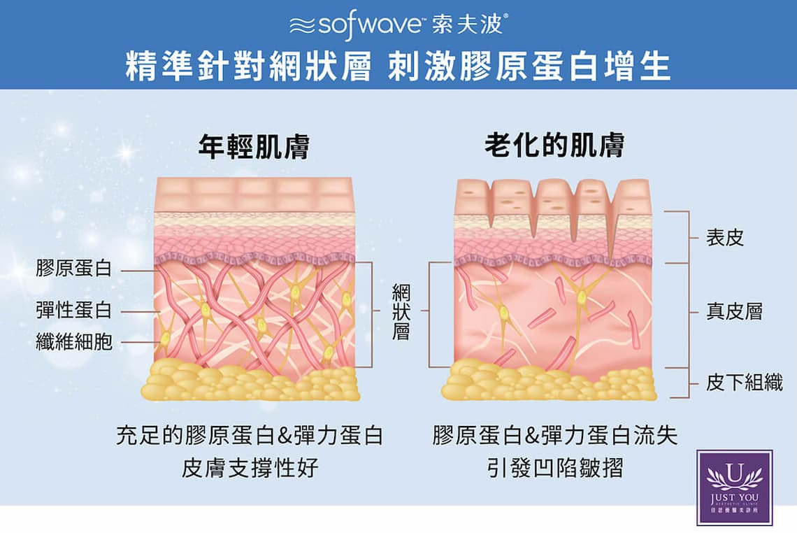 索夫波sofwave結合電音雙波的特質，柱狀體積加熱範圍更廣，刺激更多膠原蛋白。