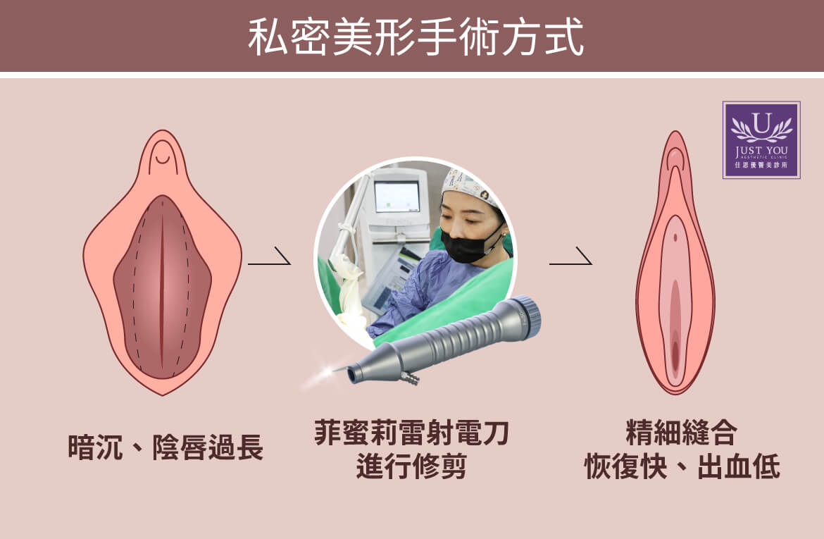 『私密美形手术』会搭配菲蜜莉雷射刀进行阴唇过长的修剪