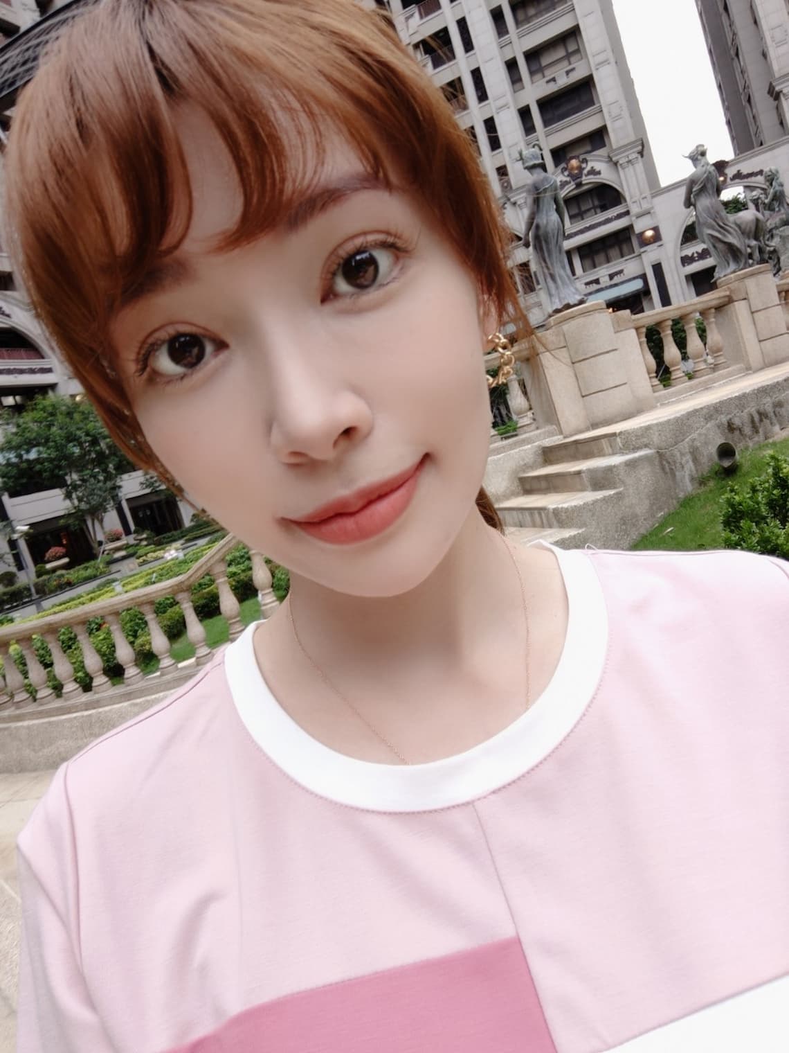 玻尿酸淚溝蘋果肌治療分享-台中醫美診所佳思優