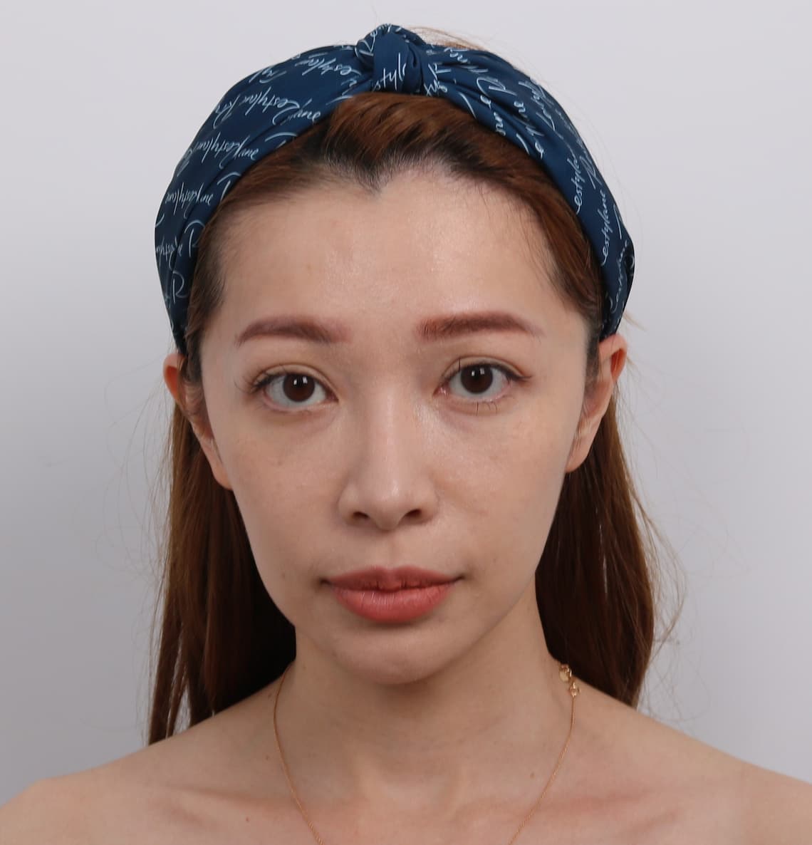 玻尿酸淚溝術前-在台中醫美診所佳思優拍攝