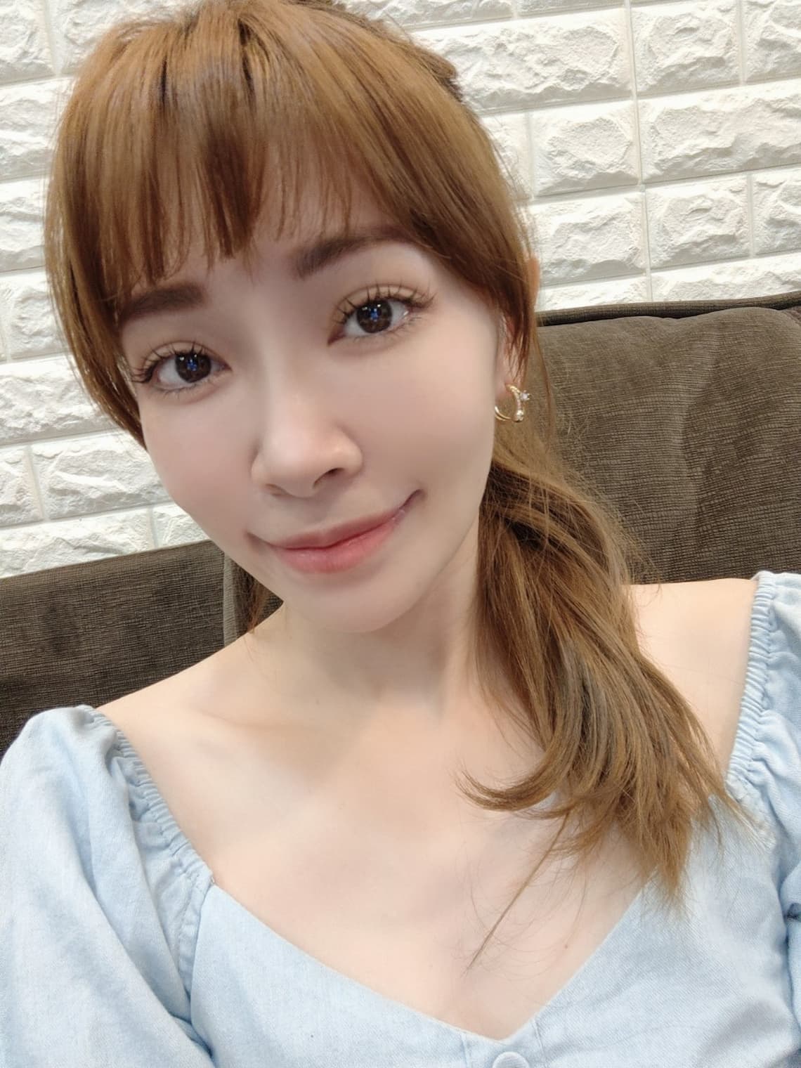 在台中醫美診所佳思優施打完玻尿酸一周後記錄