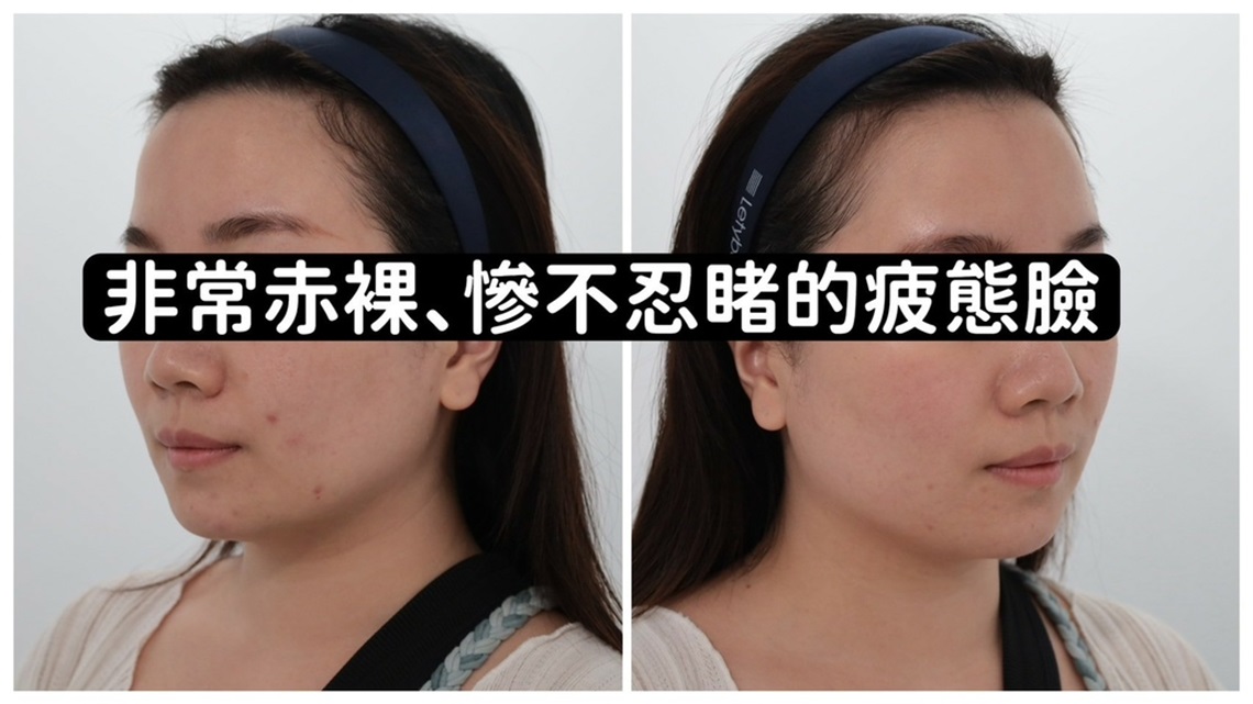 美音二代-小巨蛋佳思优术前准备