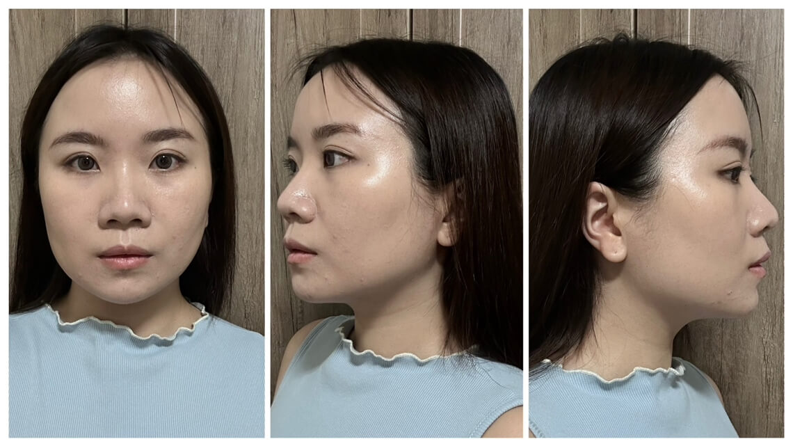 美音二代-佳思优术后分享