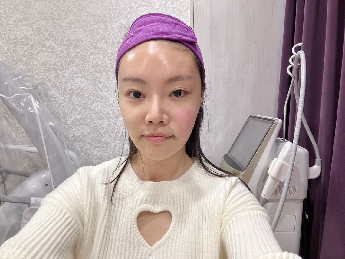 台中医美佳思优-新倍提电音双波施打完后立即效果