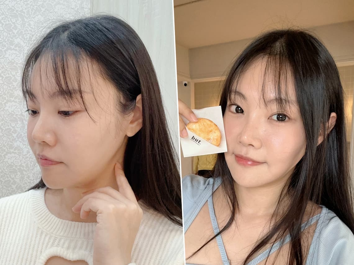 台中医美-施打新倍提术后差异对比效果