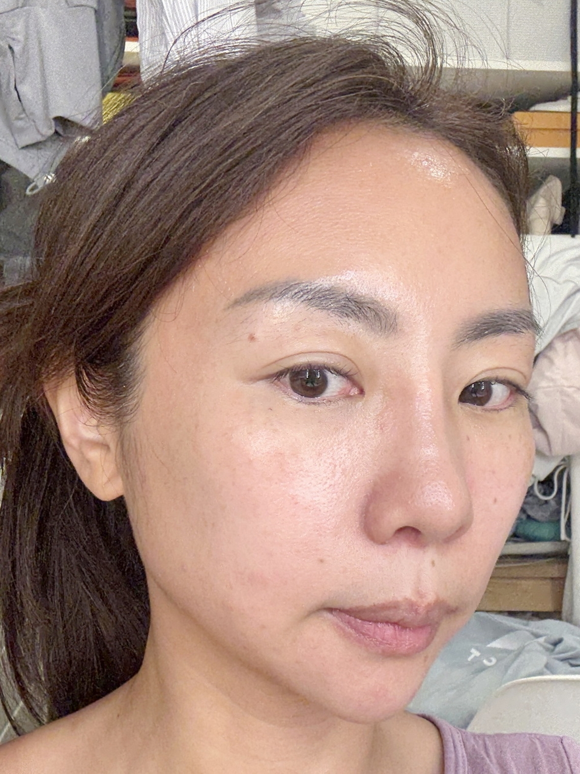 美音二代-佳思优敦北术后分享