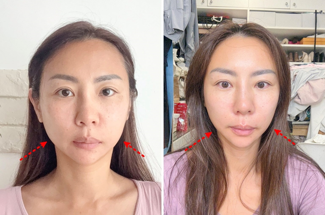 二代美音-佳思优敦北术前术后生活