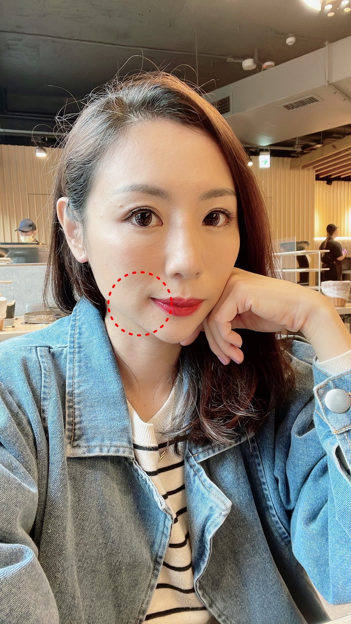 美音二代-敦北佳思优术前