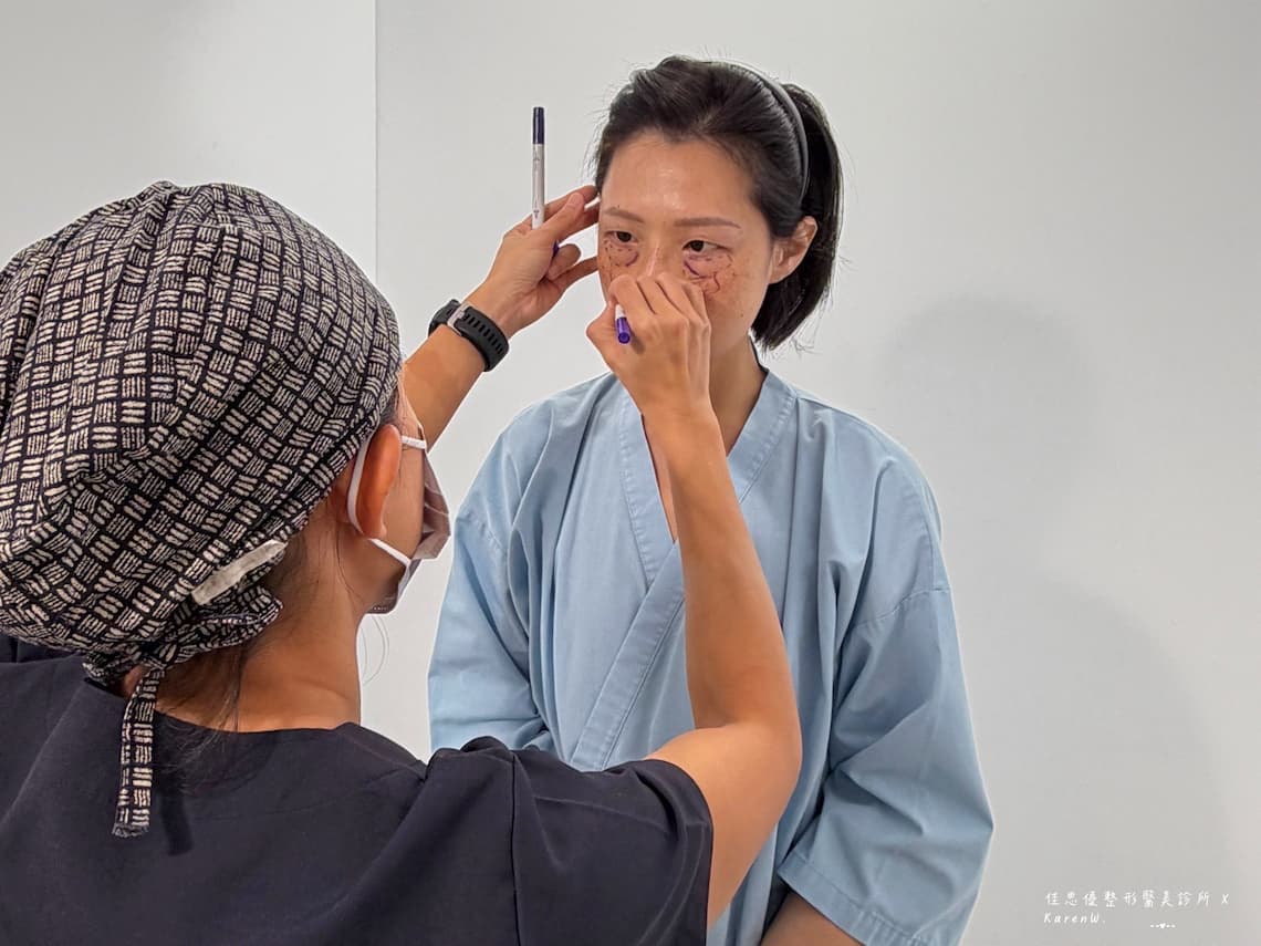 決定給佳思優醫美診所給整形外科陳依凡醫師施作五合一眼袋手術後，術前會再眼睛下方畫線，施作的地方