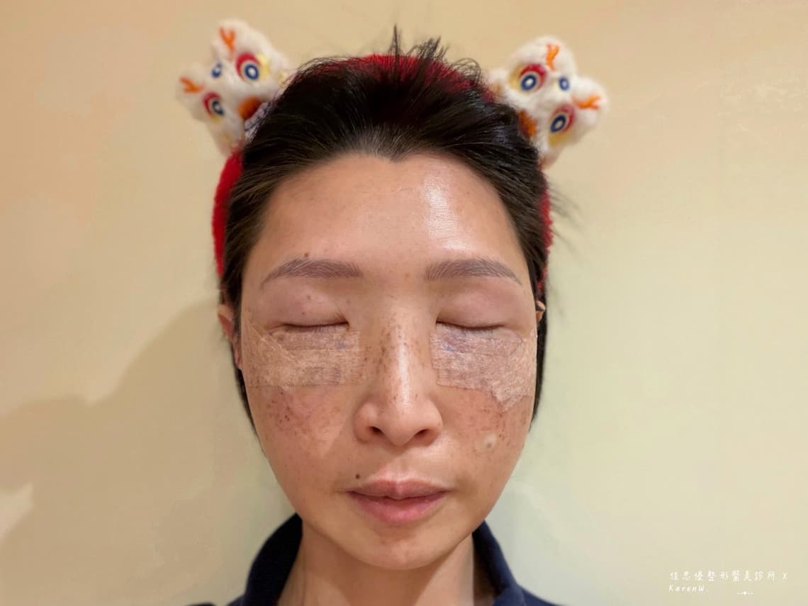 選擇給佳思優整形外科診所的陳依凡醫師做眼袋內開手術後隔天的紀錄狀況，並沒有太明顯的腫脹問題。