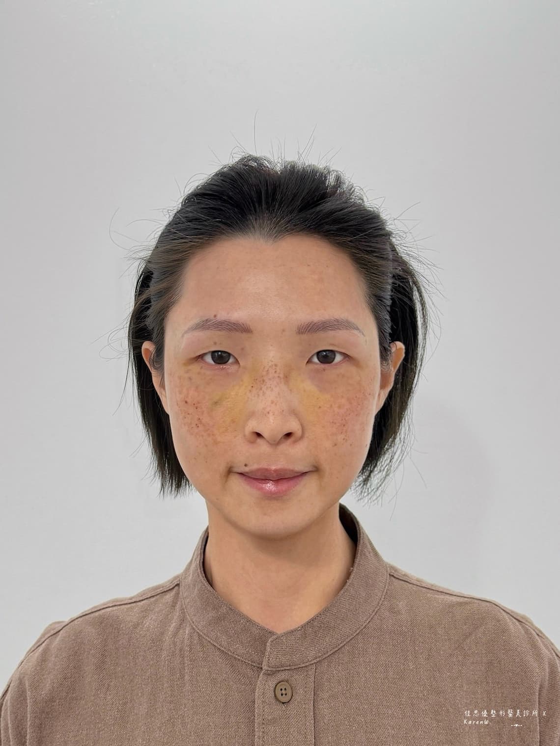 佳思優整形外科診所的陳依凡醫師做眼袋手術恢復期紀錄