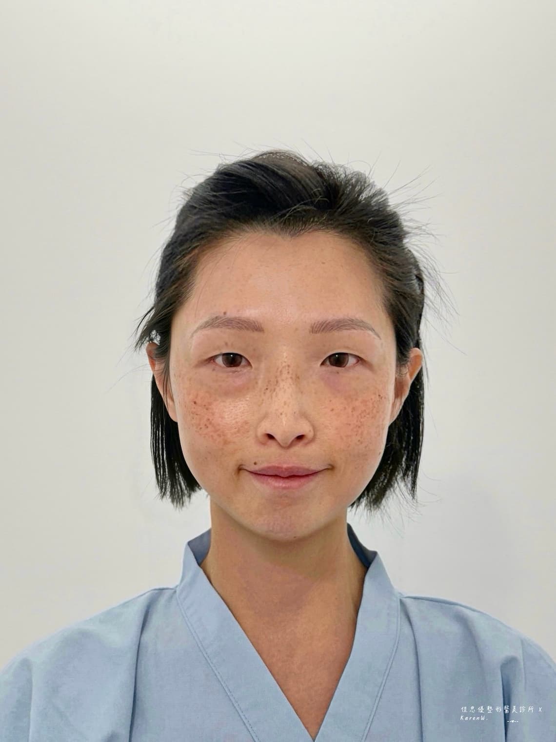 佳思優整形外科診所的陳依凡醫師做眼袋手術恢復期紀錄