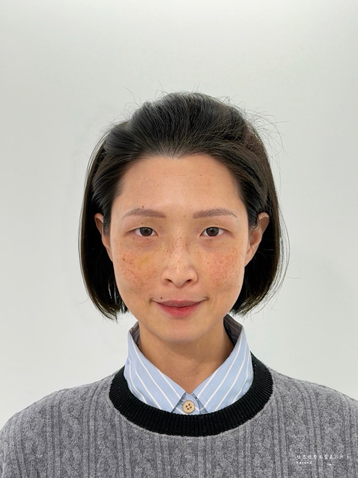 佳思優整形外科診所的陳依凡醫師做眼袋手術恢復期紀錄