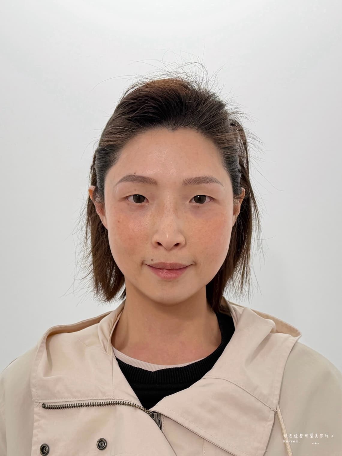 佳思優整形外科診所的陳依凡醫師做眼袋手術恢復期紀錄