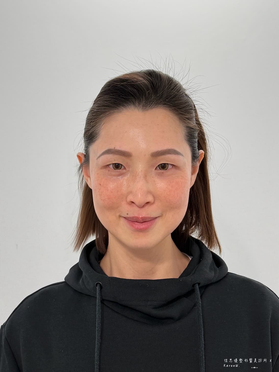 佳思優整形外科診所的陳依凡醫師做眼袋手術恢復期紀錄