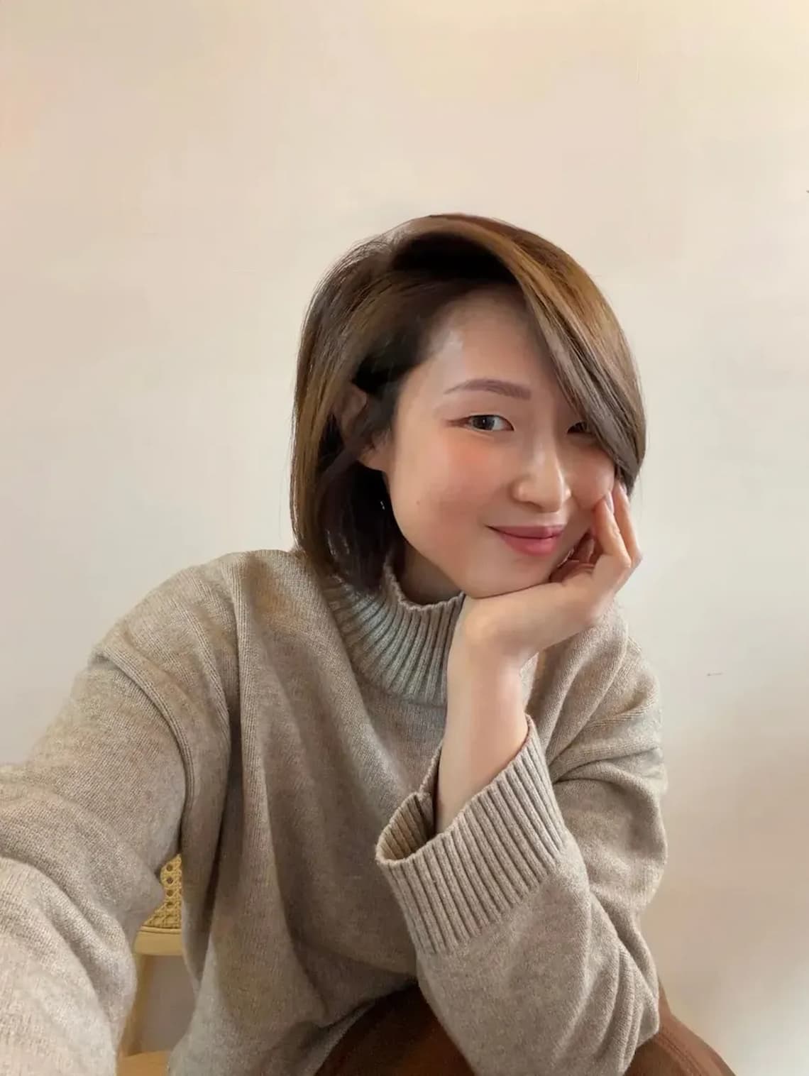 在佳思優整形外科診所的陳依凡醫師做眼袋手術後，眼下自然飽滿，非常滿意