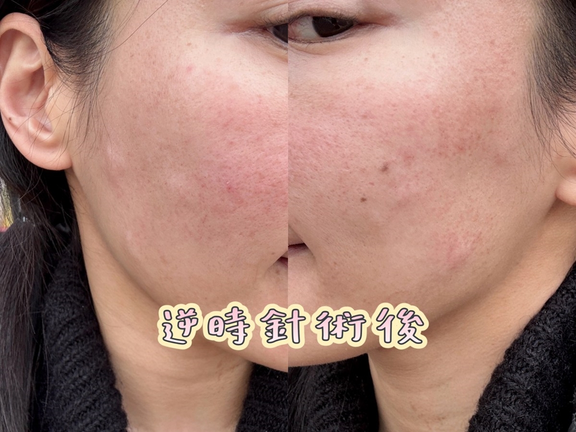 佳思优治疗逆时针一个月后的拍摄状况
