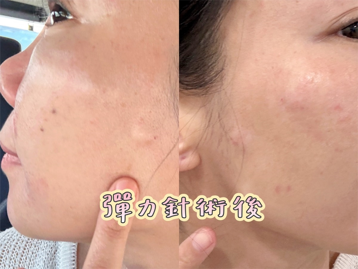 竹北佳思优弹力针治疗术后状况