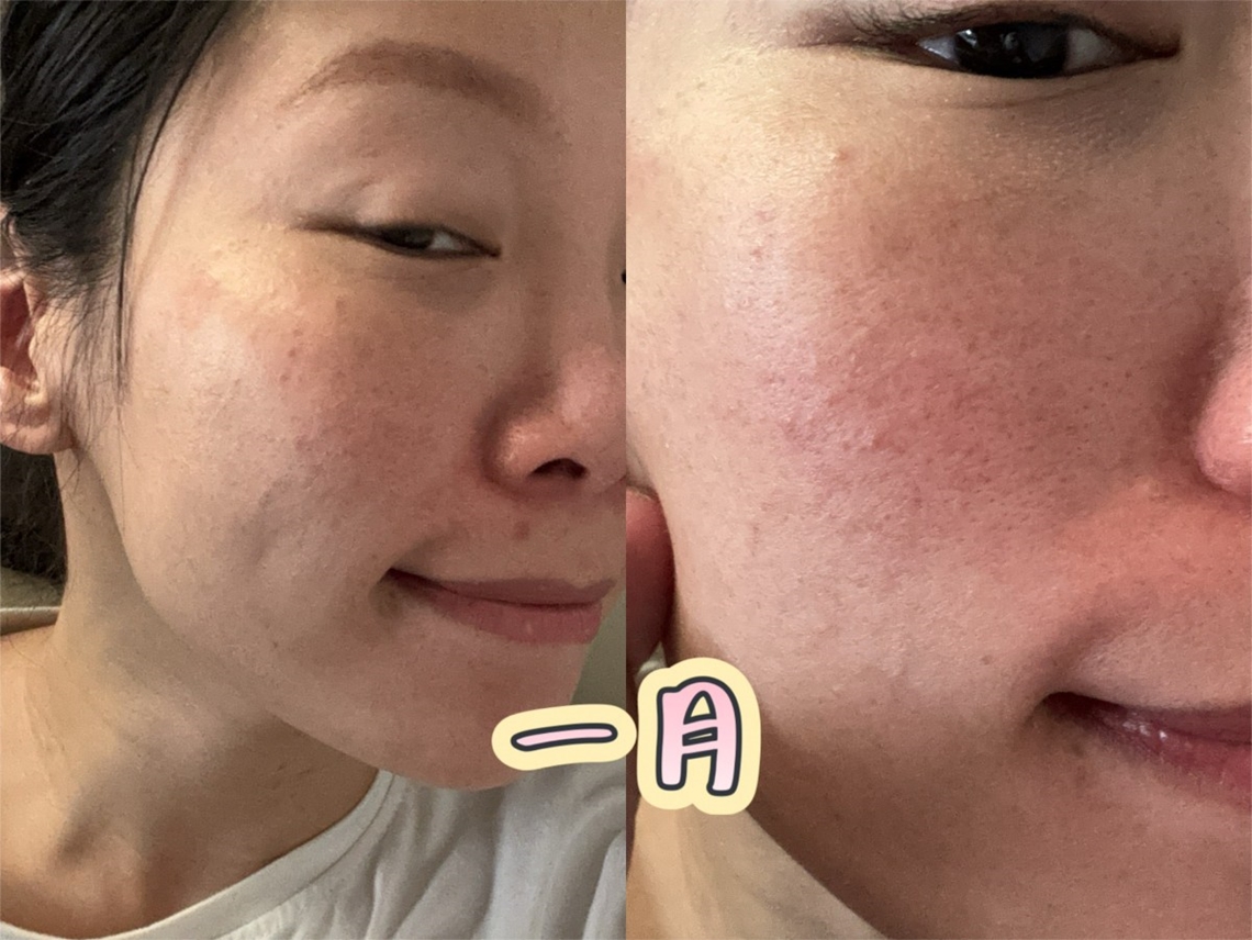 佳思优治疗逆时针素颜状态分享