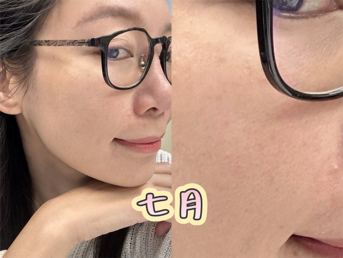 竹北佳思优弹力针治疗后皮肤状态