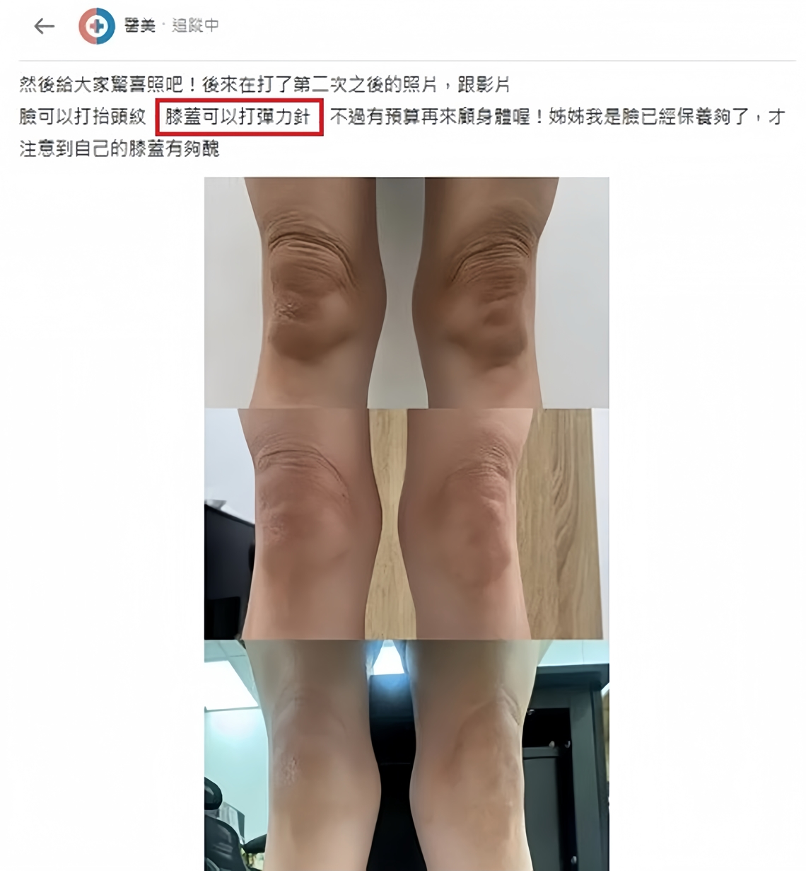 去佳思优打过弹力针dcard的网友分享她膝盖效果