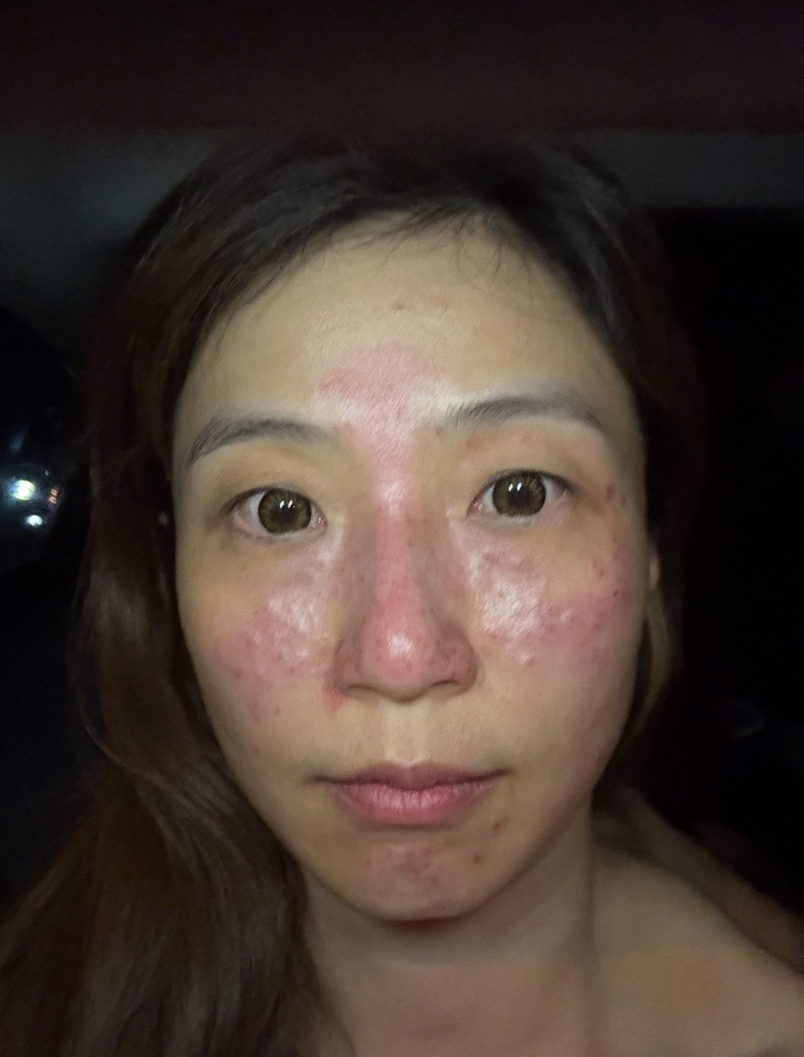 台北佳思優診所皮秒雷射客人術後立即分享