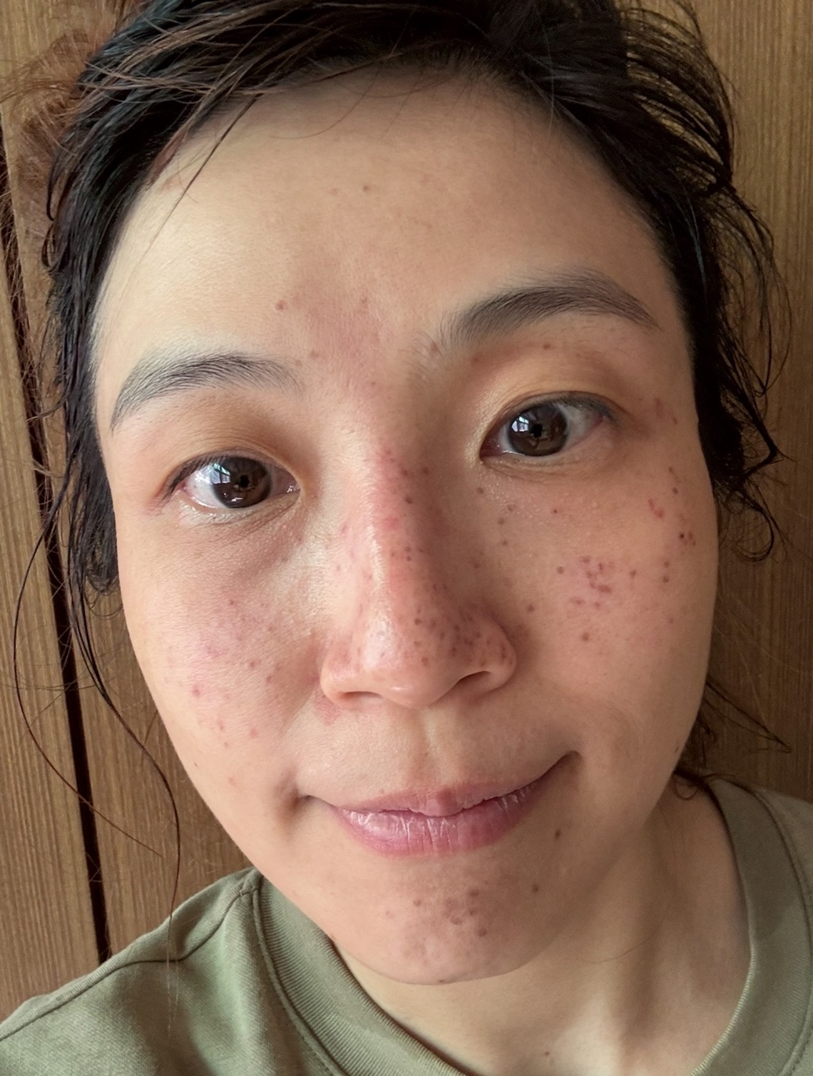敦北佳思優診所皮秒雷射客人術後一天臉部狀況