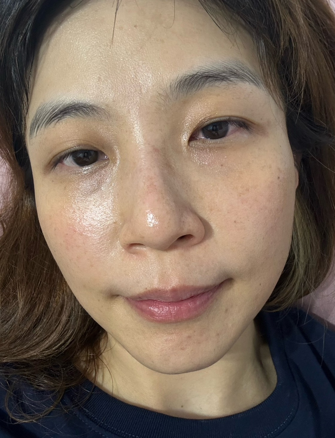 佳思優敦北分院picoplus皮秒客人術後三天情形